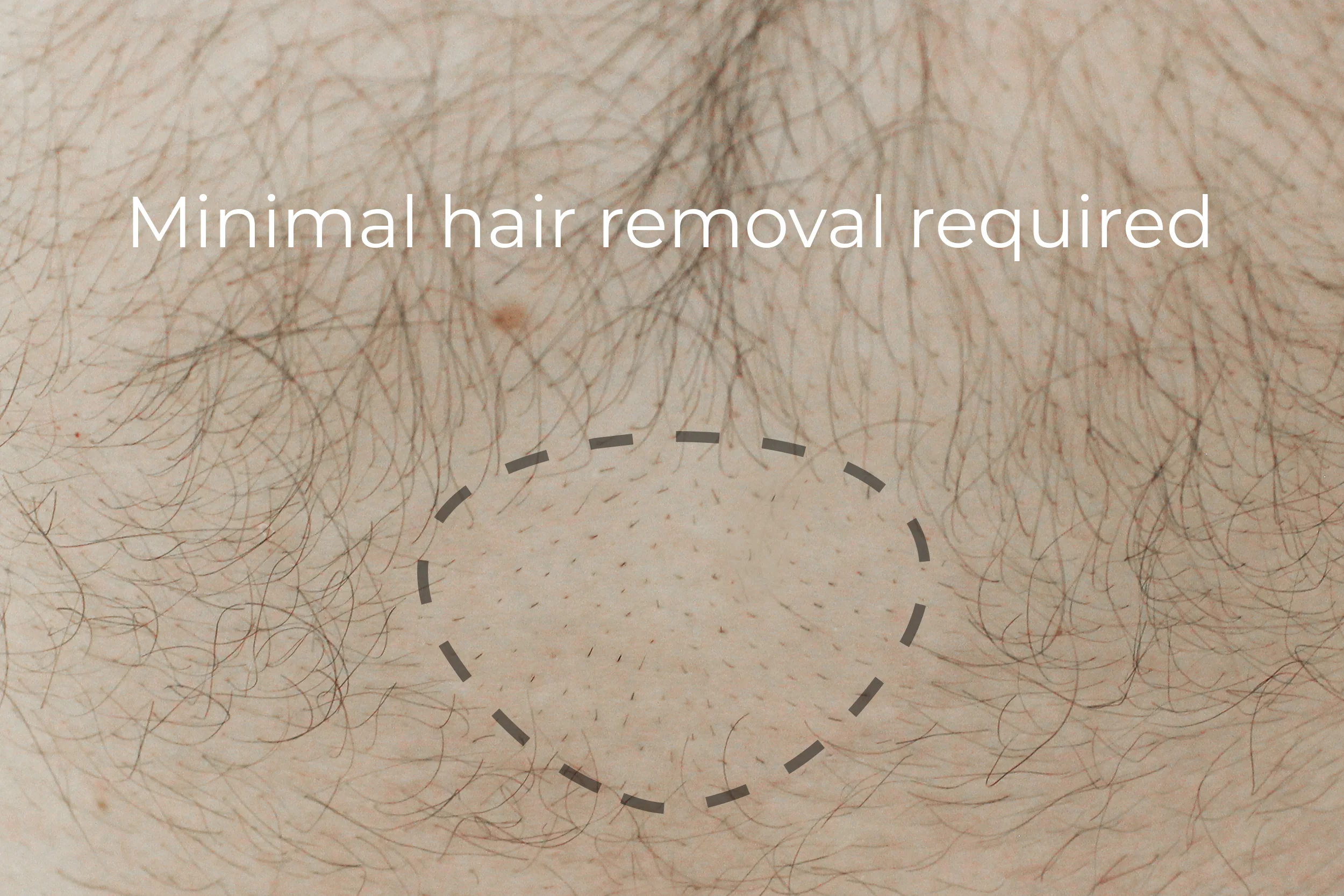 MorMe Adhesive Clip (Compatible with Original Soft Packer only) - Pack of 2 - Image 5